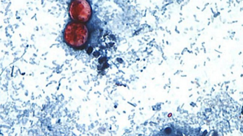 Doctor Discusses Symptoms, Tests and Treatments as Illness from Cyclosporiasis Spreads Across U.S.