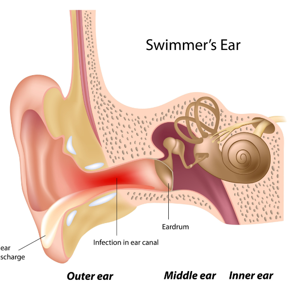 swimmer's ear symptoms and treatment
