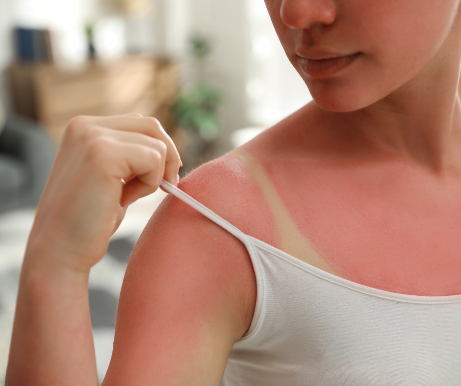 Don’t Forget the Sunscreen, or to Get Screened for Skin Cancer