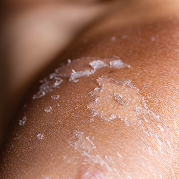 how to treat sunburn and when to see a doctor
