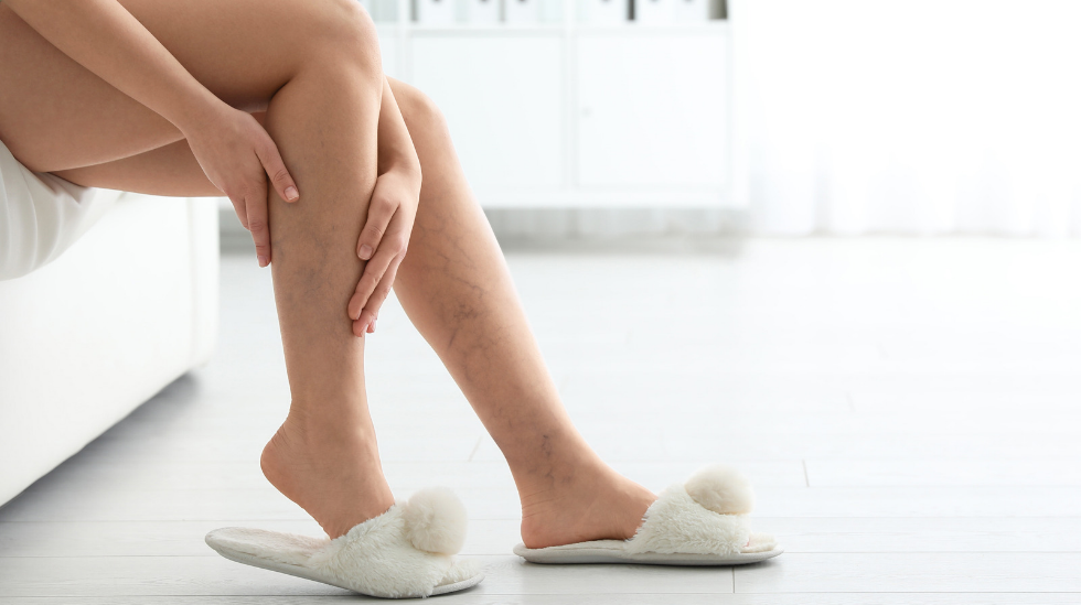Spider and Varicose Veins: What They Mean, When to Seek Treatment, and Today’s Minimally Invasive Options 