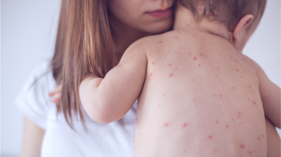 Measles Is Back in the U.S. Here’s What You Should Know 