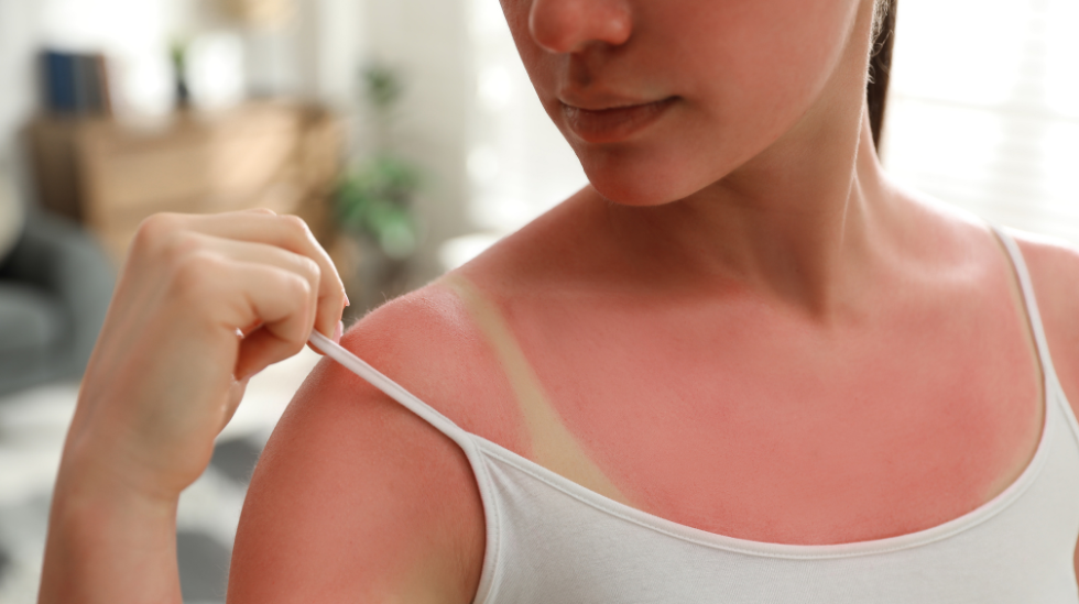 Don’t Forget the Sunscreen, or to Get Screened for Skin Cancer