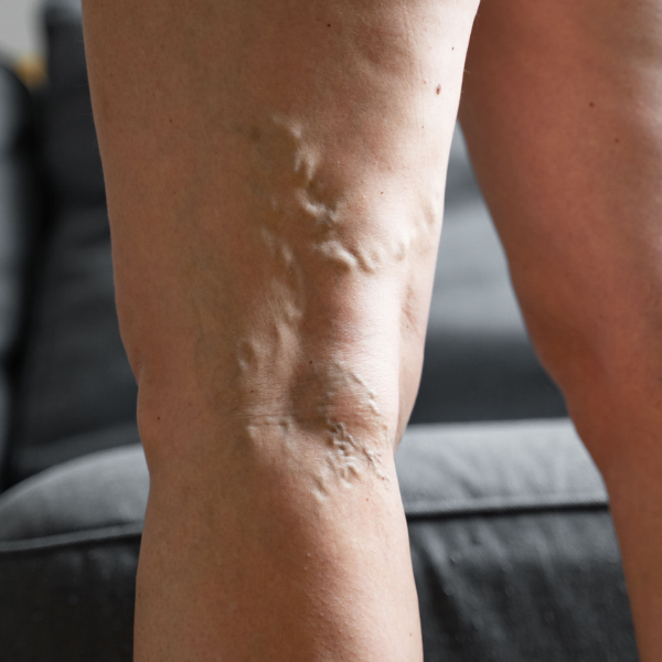 Varicose and Spider Veins