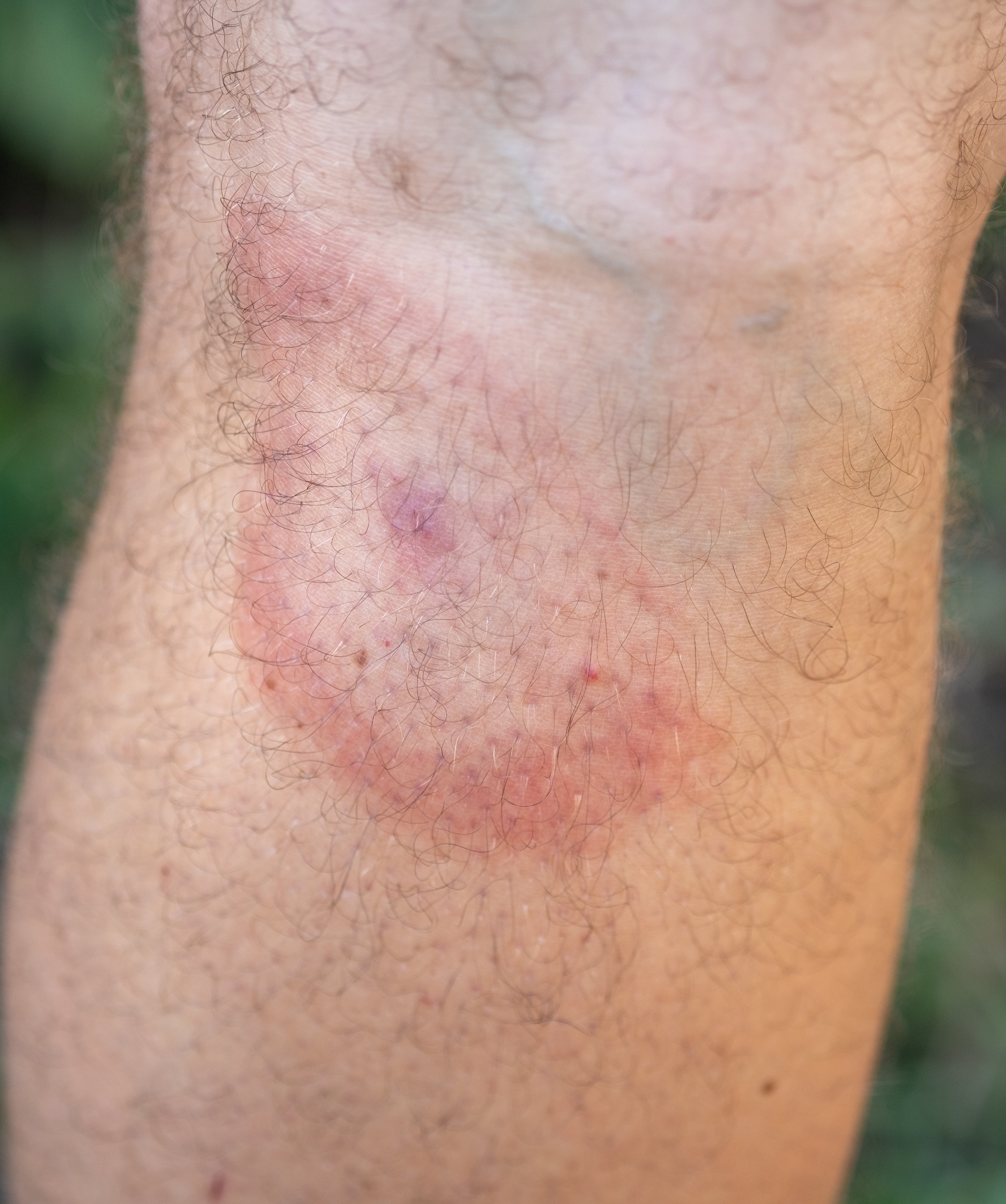 image of tick bite Southern NH Health Immediate Care