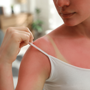 Protecting Your Skin: How to Treat Sunburn and When to Get Help 